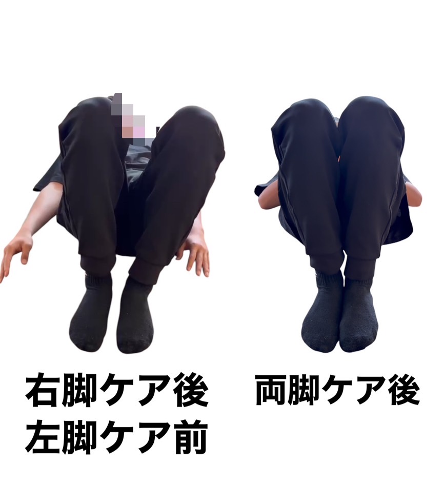 症例 2(片脚比較)